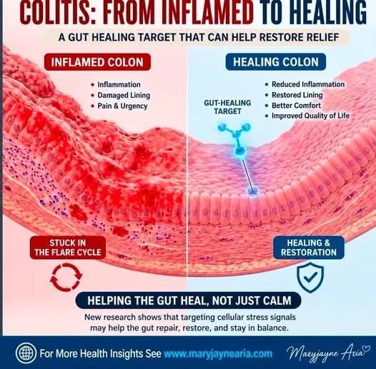 Colitis: Why Healing the Gut Is More Than Just Reducing Inflammation